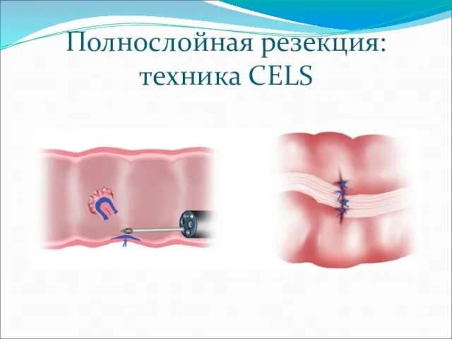 Полнослойная резекция: техника CELS