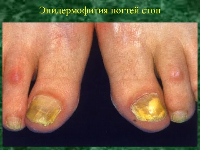 Эпидермофития ногтей стоп