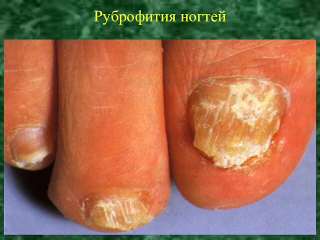 Руброфития ногтей