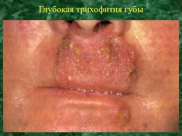 Глубокая трихофития губы