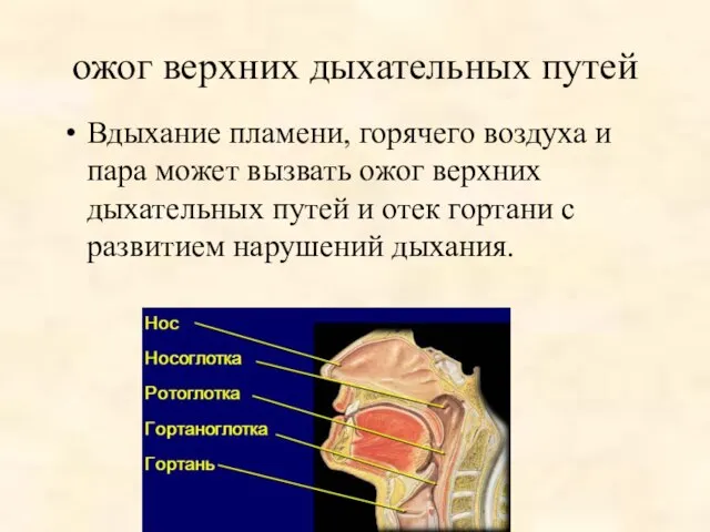 ожог верхних дыхательных путей Вдыхание пламени, горячего воздуха и пара может