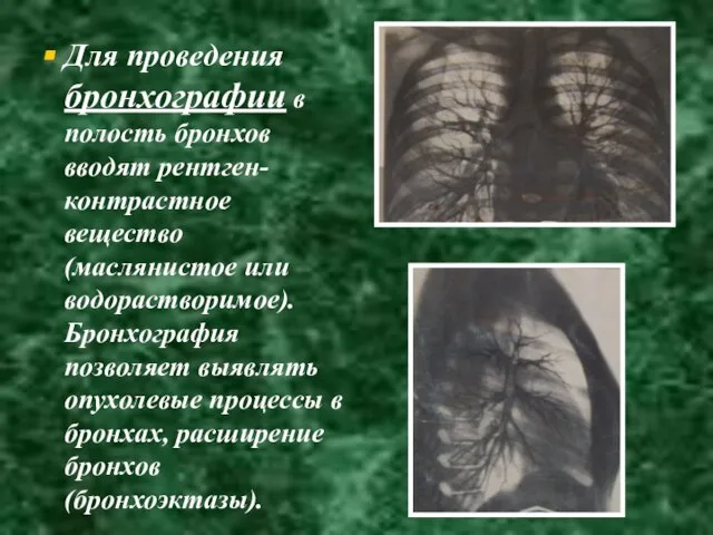 Для проведения бронхографии в полость бронхов вводят рентген-контрастное вещество (маслянистое или