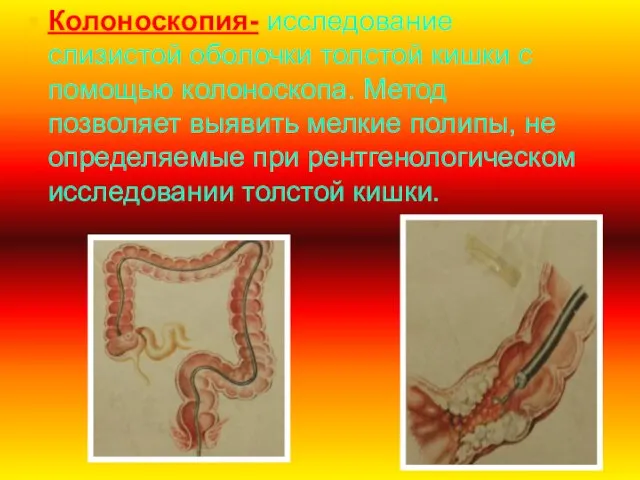 Колоноскопия- исследование слизистой оболочки толстой кишки с помощью колоноскопа. Метод позволяет