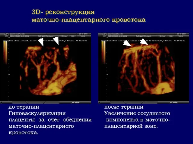 до терапии Гиповаскуляризация плаценты за счет обеднения маточно-плацентарного кровотока. после терапии