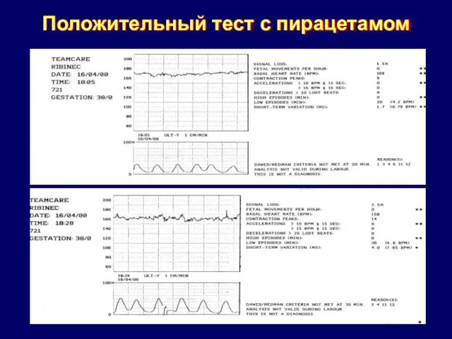 Положительный тест с пирацетамом