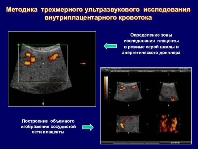 Методика трехмерного ультразвукового исследования внутриплацентарного кровотока Определение зоны исследования плаценты в