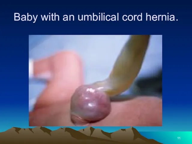 Baby with an umbilical cord hernia.