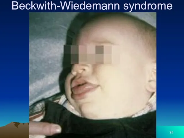 Beckwith-Wiedemann syndrome