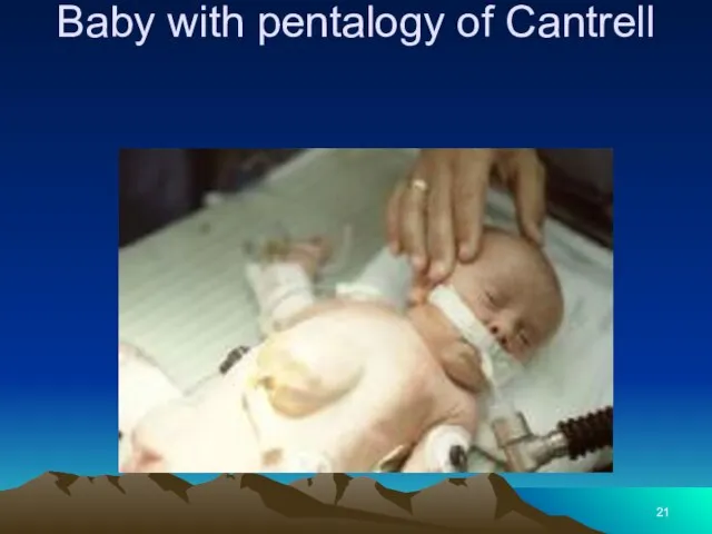 Baby with pentalogy of Cantrell