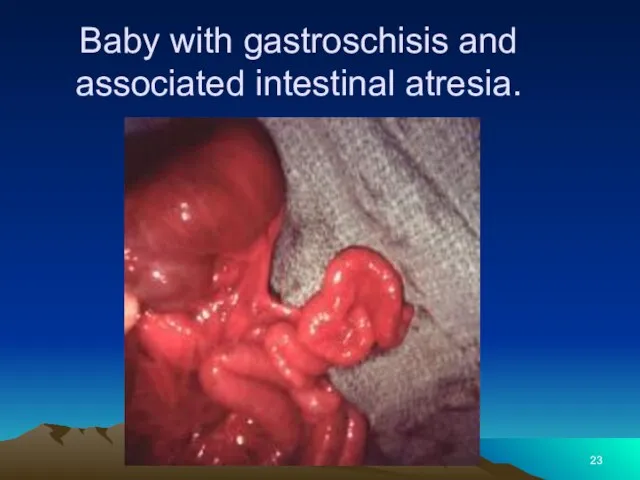 Baby with gastroschisis and associated intestinal atresia.