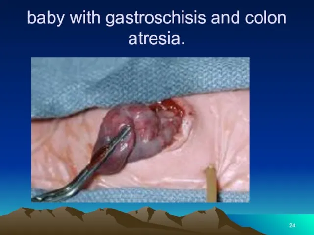 baby with gastroschisis and colon atresia.