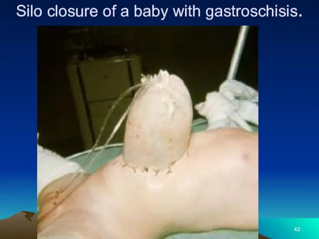 Silo closure of a baby with gastroschisis.