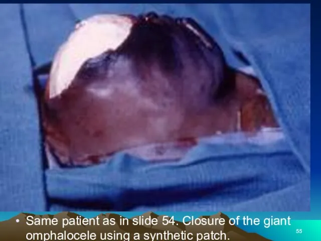 Same patient as in slide 54. Closure of the giant omphalocele using a synthetic patch.