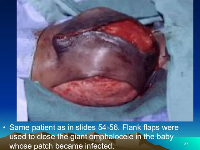 Same patient as in slides 54-56. Flank flaps were used to