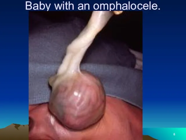 Baby with an omphalocele.