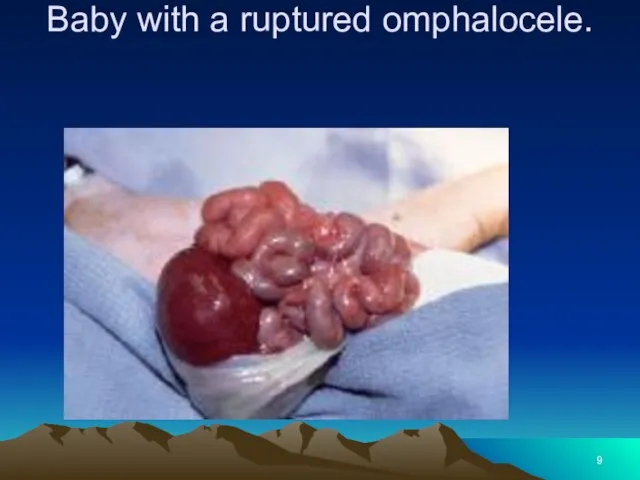 Baby with a ruptured omphalocele.