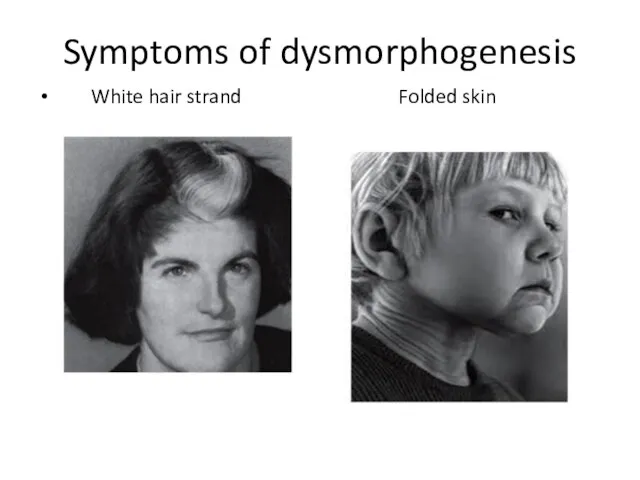 Symptoms of dysmorphogenesis White hair strand Folded skin