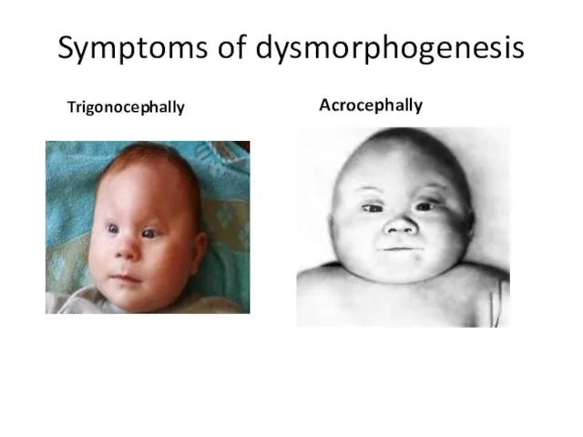 Symptoms of dysmorphogenesis Trigonocephally Acrocephally