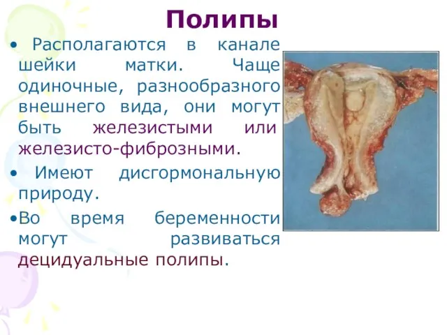 Полипы Располагаются в канале шейки матки. Чаще одиночные, разнообразного внешнего вида,