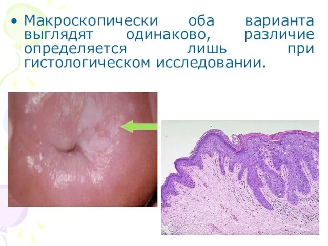 Макроскопически оба варианта выглядят одинаково, различие определяется лишь при гистологическом исследовании.