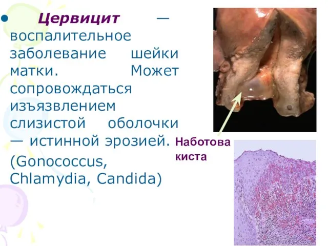 Цервицит — воспалительное заболевание шейки матки. Может сопровождаться изъязвлением слизистой оболочки