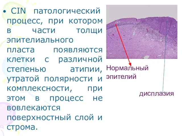 CIN патологический процесс, при котором в части толщи эпителиального пласта появляются