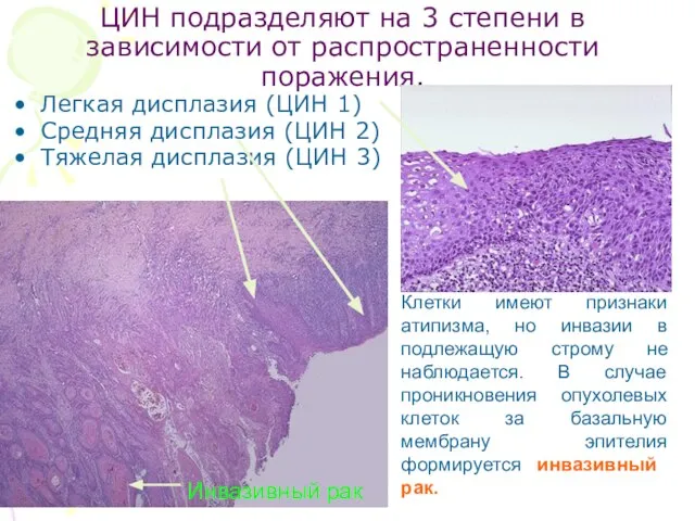 ЦИН подразделяют на 3 степени в зависимости от распространенности поражения. Легкая