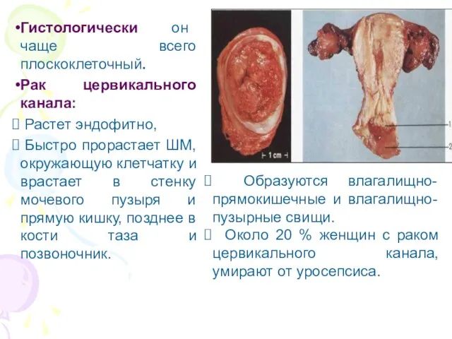 Гистологически он чаще всего плоскоклеточный. Рак цервикального канала: Растет эндофитно, Быстро