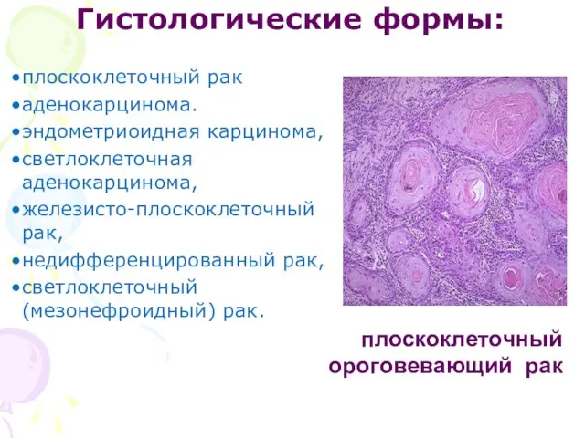 Гистологические формы: плоскоклеточный рак аденокарцинома. эндометриоидная карцино­ма, светлоклеточная аденокарцинома, железисто-плоскоклеточный рак,