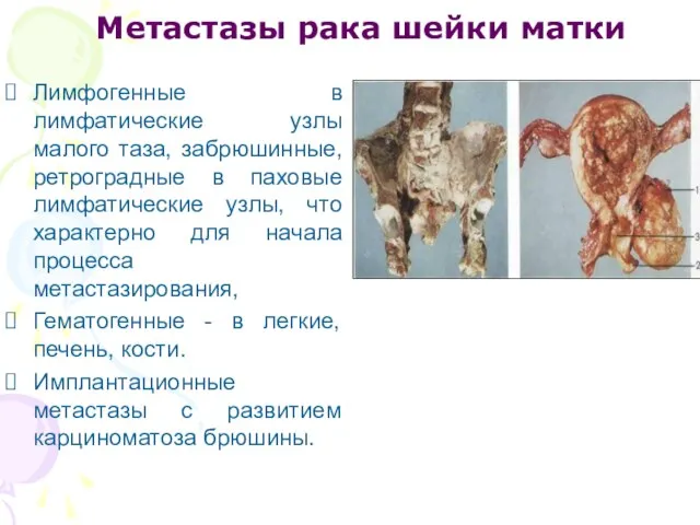 Метастазы рака шейки матки Лимфогенные в лимфатические узлы малого таза, забрюшинные,