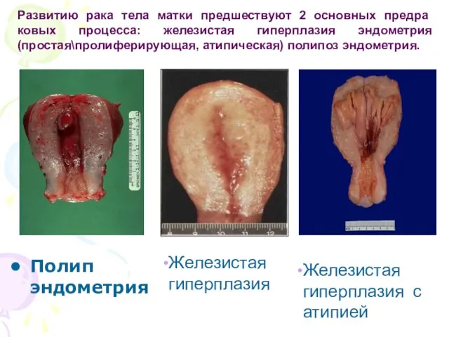 Полип эндометрия Железистая гиперплазия Развитию рака тела матки предшествуют 2 основных