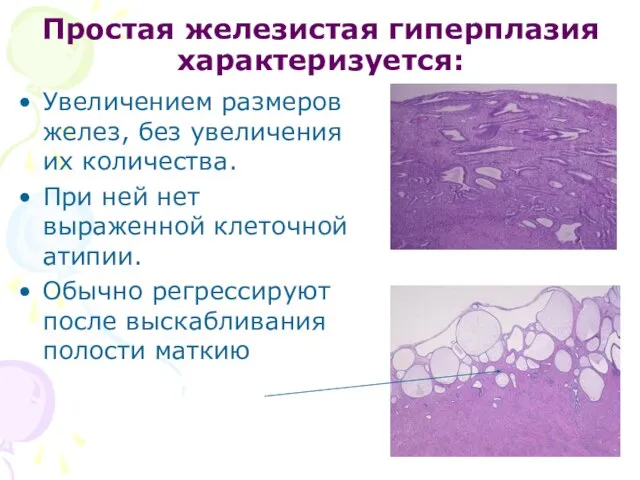 Простая железистая гиперплазия характеризуется: Увеличением размеров желез, без увеличения их количества.