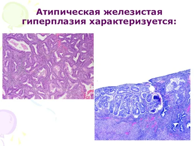 Атипическая железистая гиперплазия характеризуется: