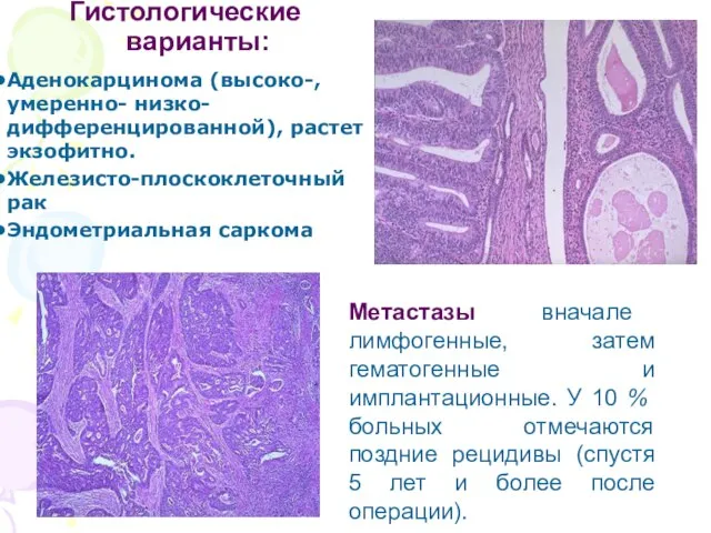 Гистологические варианты: Аденокарцинома (высоко-, умеренно- низко-дифференцированной), растет экзофитно. Железисто-плоскоклеточный рак Эндометриальная