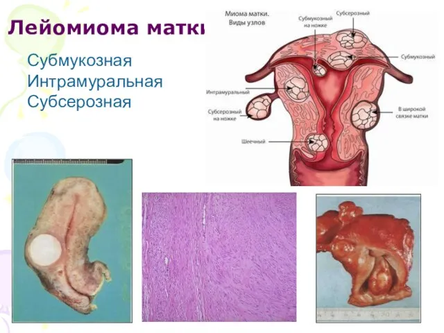 Лейомиома матки Субмукозная Интрамуральная Субсерозная