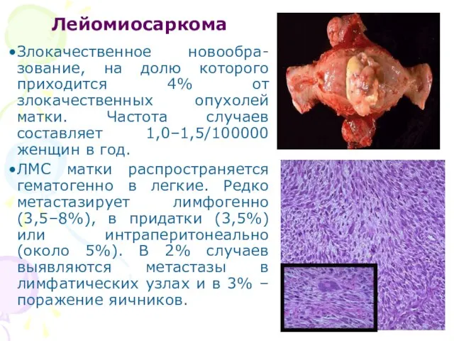 Лейомиосаркома Злокачественное новообра-зование, на долю которого приходится 4% от злокачественных опухолей