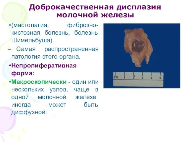 Доброкачественная дисплазия молочной железы (мастопатия, фиброзно-кистозная болезнь, болезнь Шимельбуша) Самая распространенная