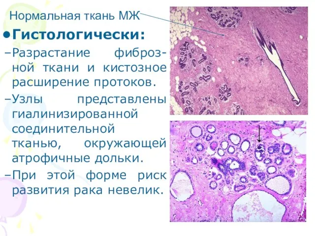 Гистологически: Разрастание фиброз-ной ткани и кистозное расширение протоков. Узлы представлены гиалинизированной