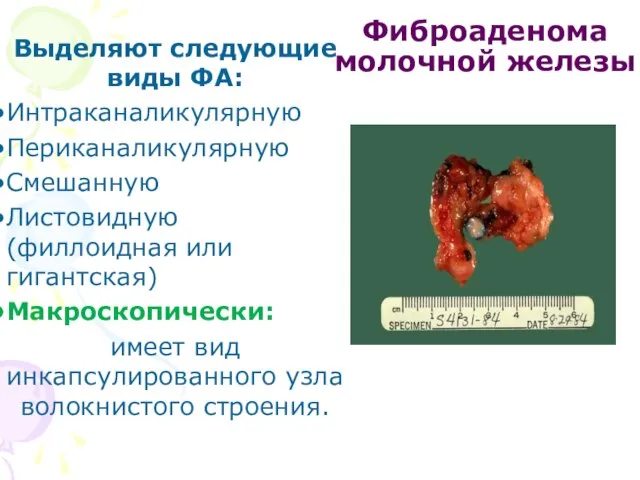 Фиброаденома молочной железы Выделяют следующие виды ФА: Интраканаликулярную Периканаликулярную Смешанную Листовидную