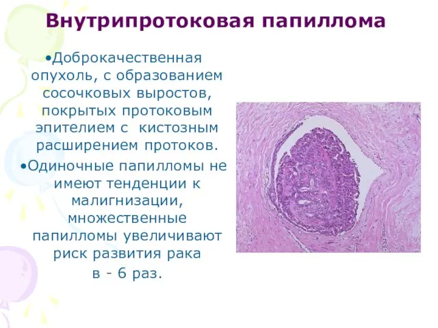 Внутрипротоковая папиллома Доброкачественная опухоль, с образованием сосочковых выростов, покрытых протоковым эпителием