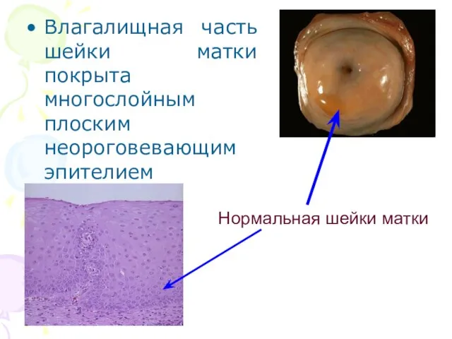 Влагалищная часть шейки матки покрыта многослойным плоским неороговевающим эпителием Нормальная шейки матки