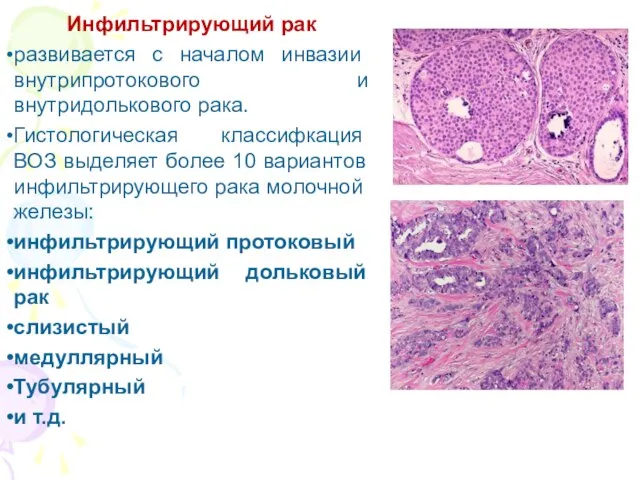 Инфильтрирующий рак развивается с началом инва­зии внутрипротокового и внутридолькового рака. Гистологиче­ская