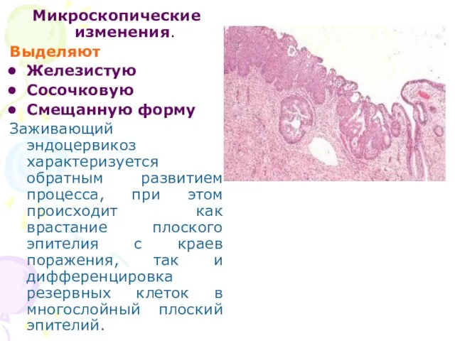 Микроскопические изменения. Выделяют Железистую Сосочковую Смещанную форму Заживающий эндоцервикоз характеризуется обратным