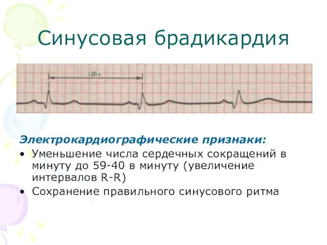 Синусовая брадикардия Электрокардиографические признаки: Уменьшение числа сердечных сокращений в минуту до