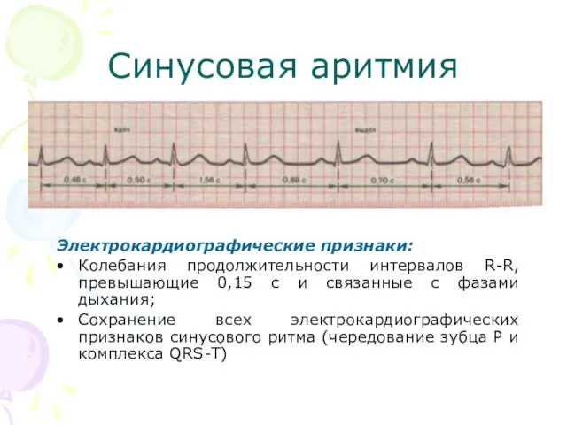 Синусовая аритмия Электрокардиографические признаки: Колебания продолжительности интервалов R-R, превышающие 0,15 с