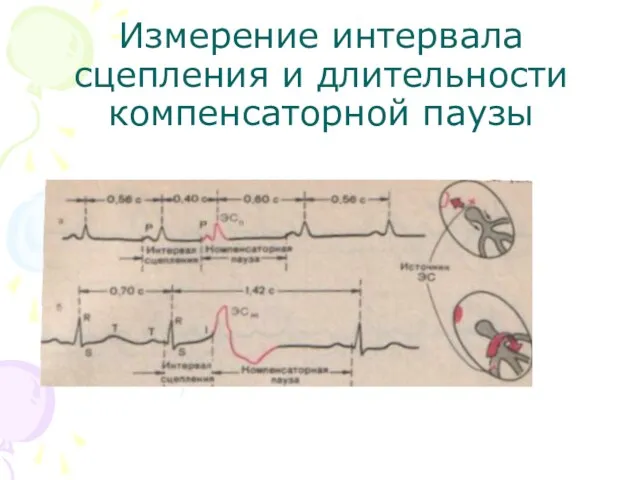 Измерение интервала сцепления и длительности компенсаторной паузы