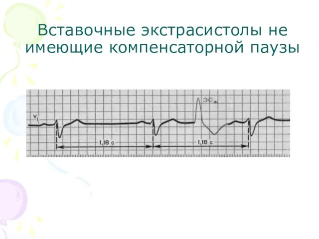 Вставочные экстрасистолы не имеющие компенсаторной паузы