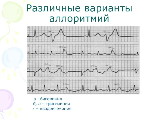 Различные варианты аллоритмий а –бигеминия б, в – тригеминия г – квадригеминия