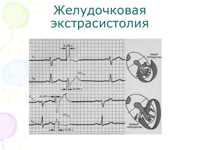 Желудочковая экстрасистолия