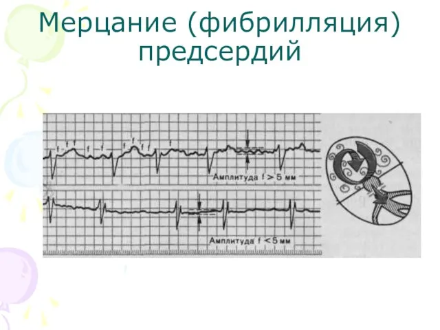 Мерцание (фибрилляция) предсердий